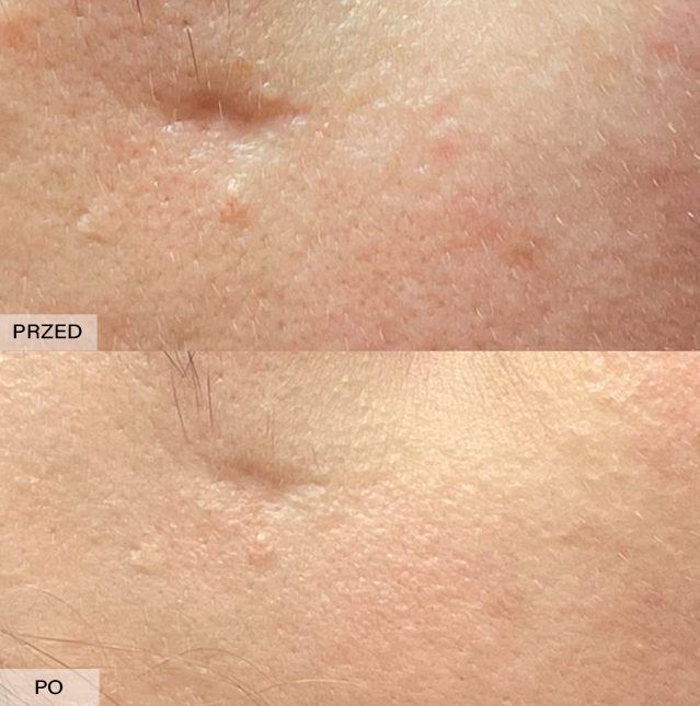 usuwanie blizn efekty